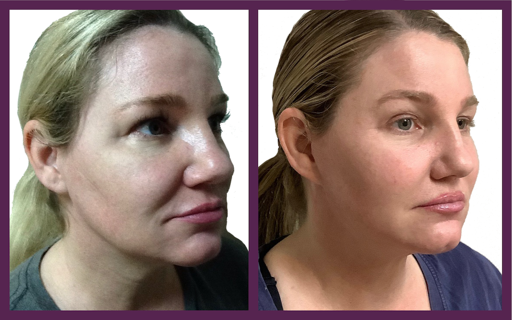 The HourLift Mini Facelift Look 10 Years Younger Benefits and