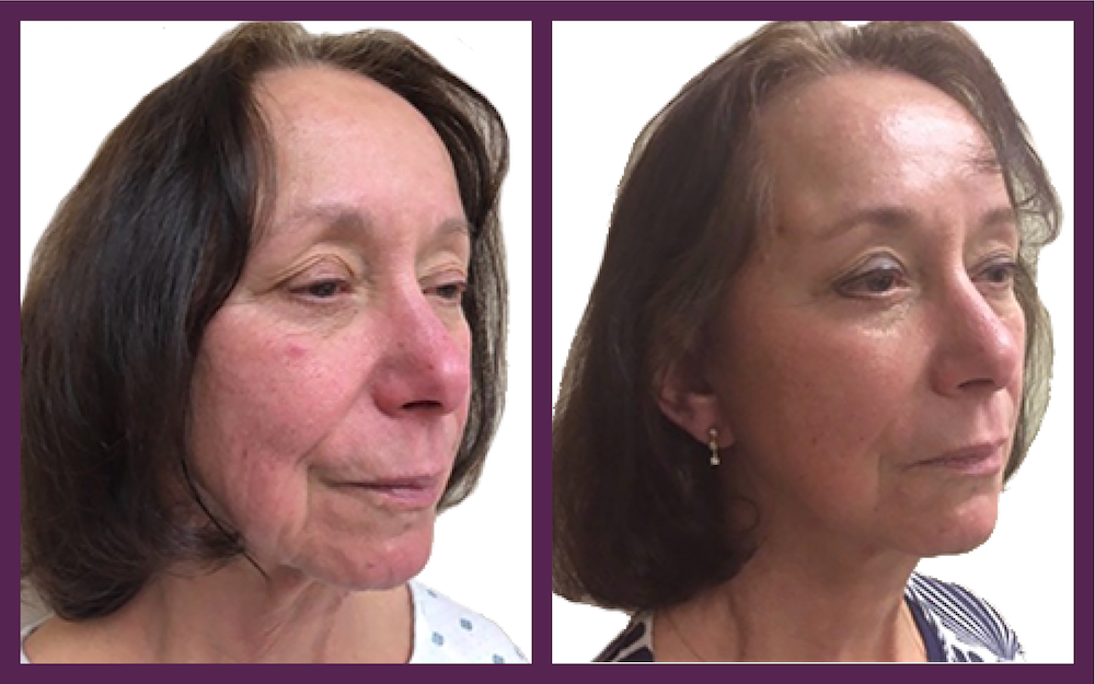 The HourLift Mini Facelift Look 10 Years Younger Benefits and