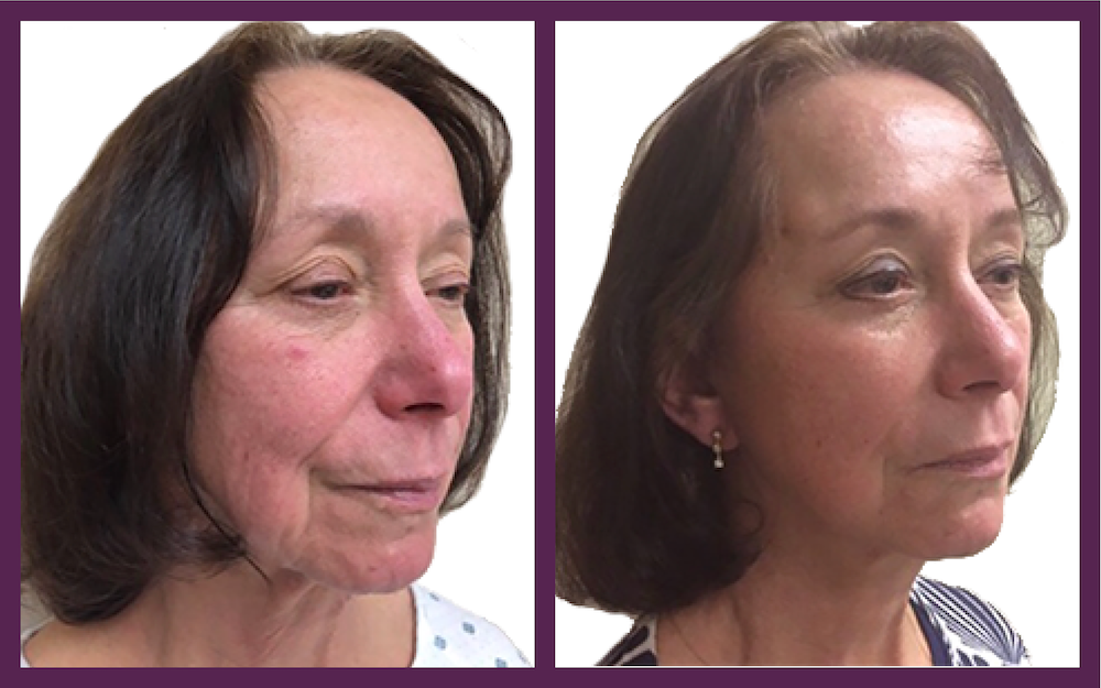 Facelift, Facial Cosmetic Surgery, Michigan Medicine