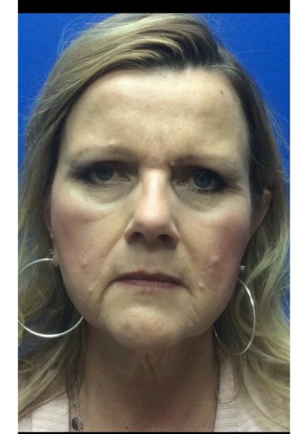 HourLift Before & After Patient #9270