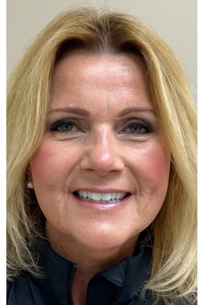 HourLift Before & After Patient #9270