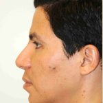 Y Lift Before & After Patient #9325