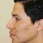 Y Lift Before & After Patient #9325