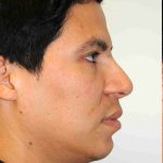 Y Lift Before & After Patient #9325