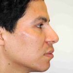 Y Lift Before & After Patient #9325