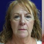 Mini Facelift Before & After Patient #9199