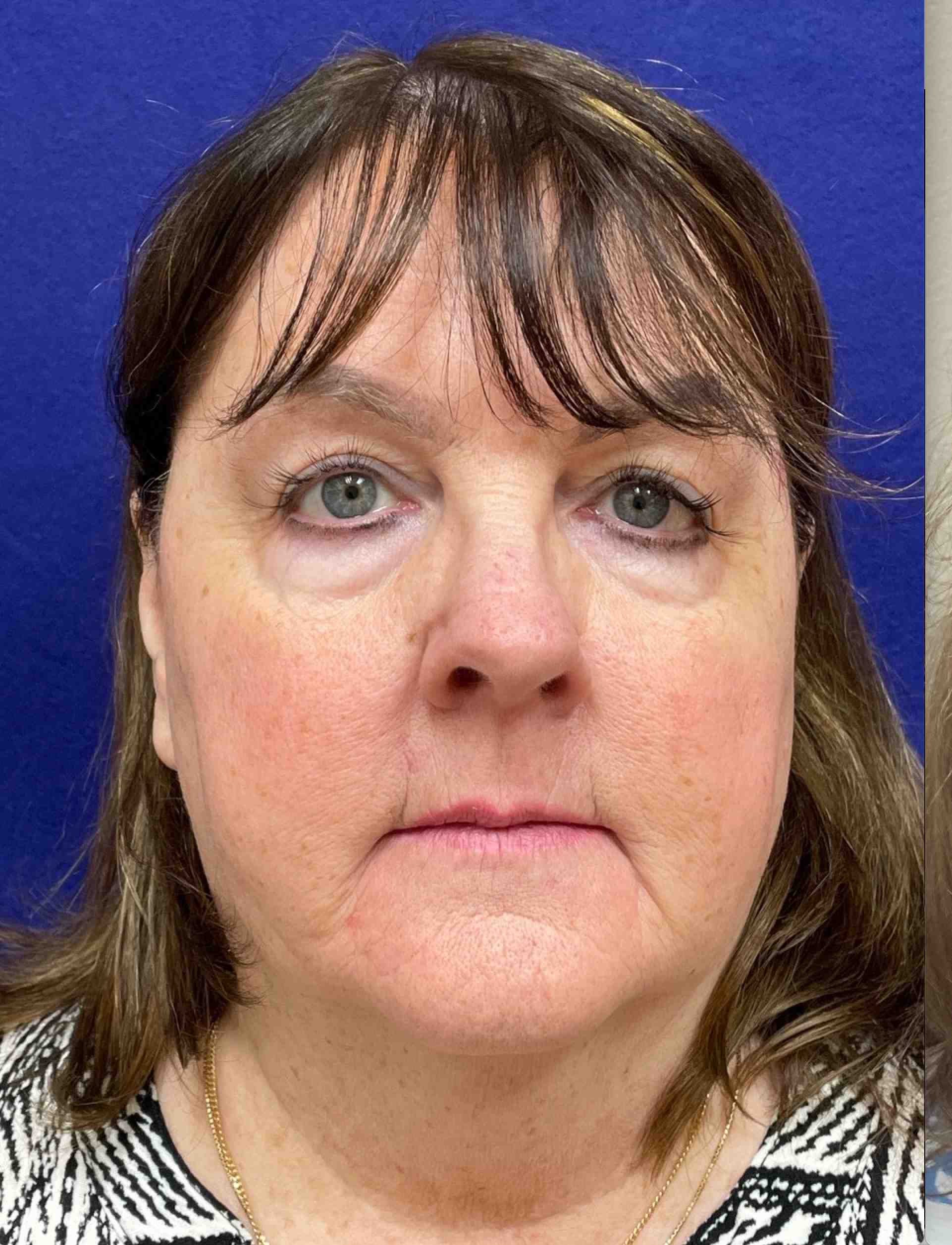 HourLift Before & After Patient #9194