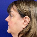 HourLift Before & After Patient #9194