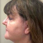 HourLift Before & After Patient #9194