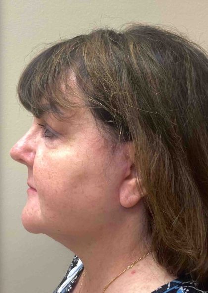 HourLift Before & After Patient #9194