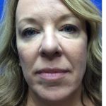 HourLift Before & After Patient #9319