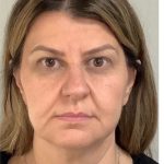 Mini Facelift Before & After Patient #9313