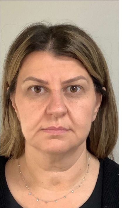 Mini Facelift Before & After Patient #9313