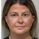 Mini Facelift Before & After Patient #9313