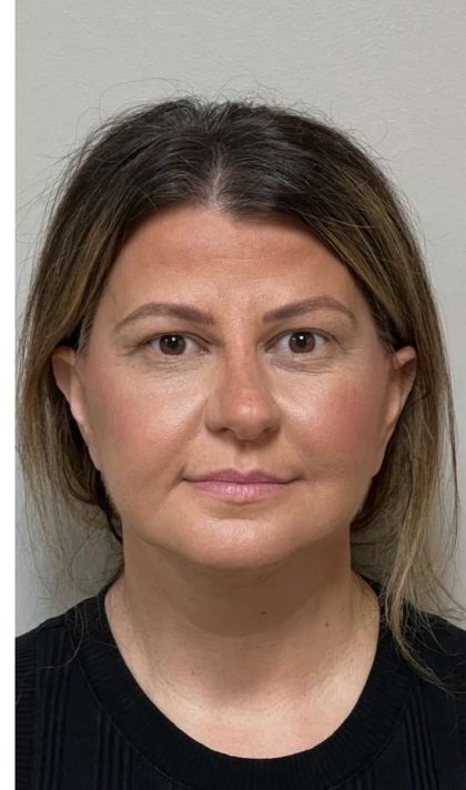 Mini Facelift Before & After Patient #9313