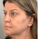 Mini Facelift Before & After Patient #9313