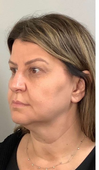 Mini Facelift Before & After Patient #9313