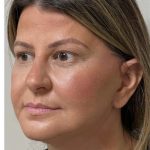 Mini Facelift Before & After Patient #9313