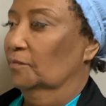 Mini Facelift Before & After Patient #9288