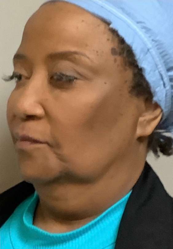Mini Facelift Before & After Patient #9288