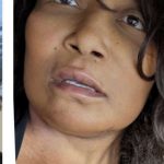 Mini Facelift Before & After Patient #9288