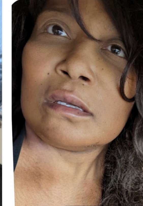 Mini Facelift Before & After Patient #9288