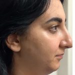 Mini Facelift Before & After Patient #9299
