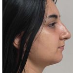 Mini Facelift Before & After Patient #9299