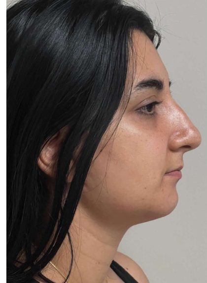 Mini Facelift Before & After Patient #9299