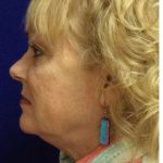Mini Facelift Before & After Patient #9303