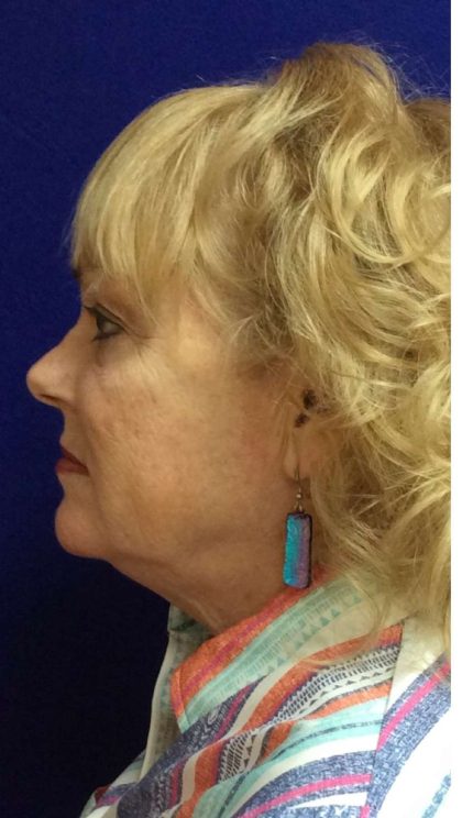 Mini Facelift Before & After Patient #9303