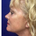 Mini Facelift Before & After Patient #9303