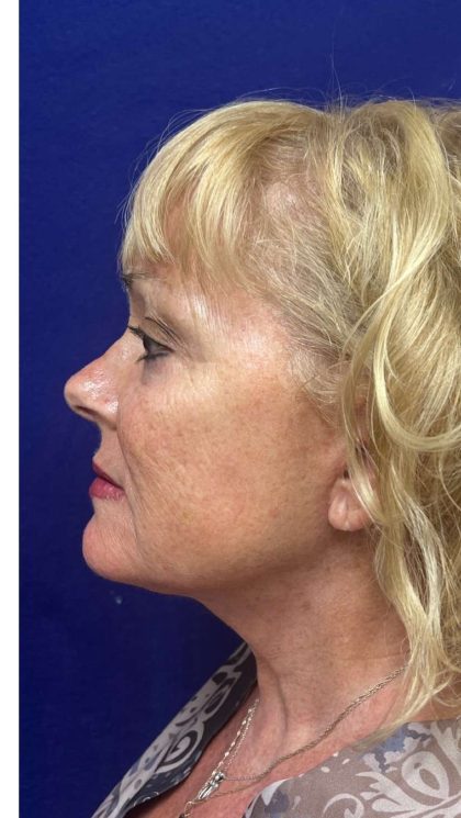Mini Facelift Before & After Patient #9303