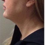 Mini Facelift Before & After Patient #9306