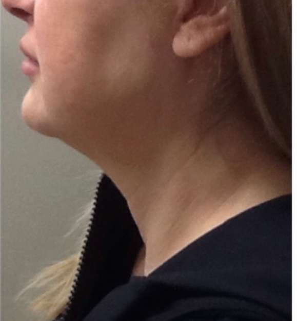 Mini Facelift Before & After Patient #9306