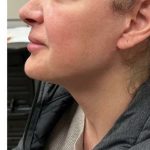 Mini Facelift Before & After Patient #9306