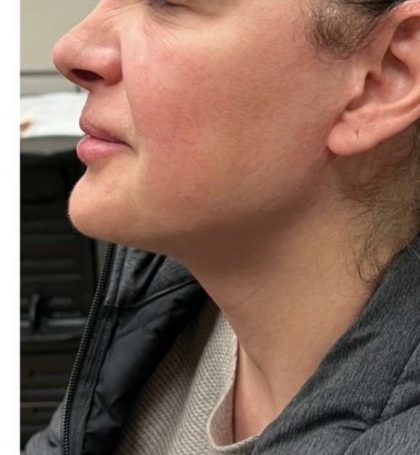 Mini Facelift Before & After Patient #9306