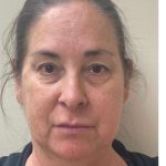 Mini Facelift Before & After Patient #9310