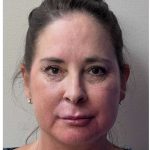 Mini Facelift Before & After Patient #9310