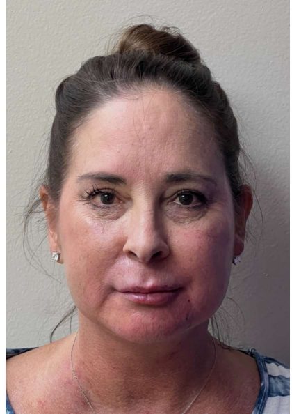 Mini Facelift Before & After Patient #9310