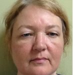 Mini Facelift Before & After Patient #9287