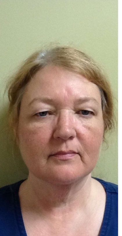 Mini Facelift Before & After Patient #9287