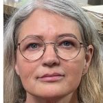 Mini Facelift Before & After Patient #9287