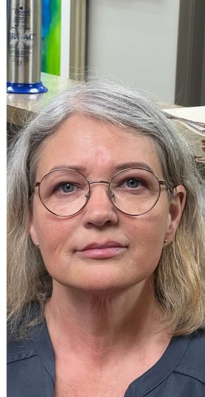 Mini Facelift Before & After Patient #9287