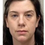 HourLift Before & After Patient #9211