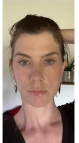 HourLift Before & After Patient #9211