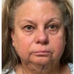 Revanesse Versa - Cheeks Before & After Patient #9205