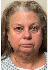 Revanesse Versa - Cheeks Before & After Patient #9205