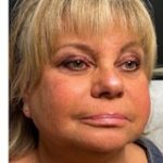 Revanesse Versa - Cheeks Before & After Patient #9205