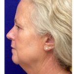 HourLift Before & After Patient #9208